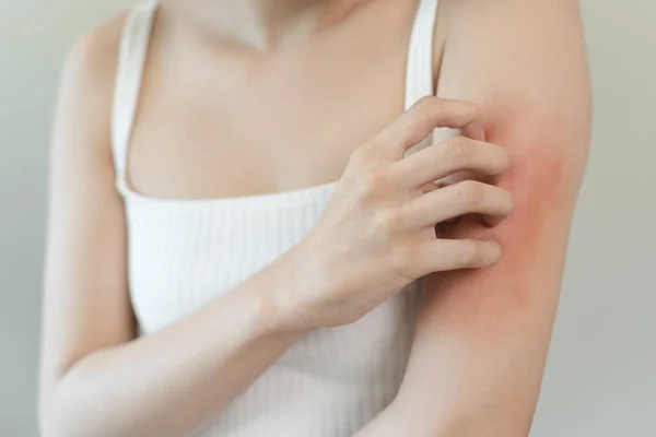 Wrażliwa Koncepcja Alergii Skóry Swędzenie Kobiety Ramieniu Czerwoną Wysypkę Objawów — Zdjęcie stockowe