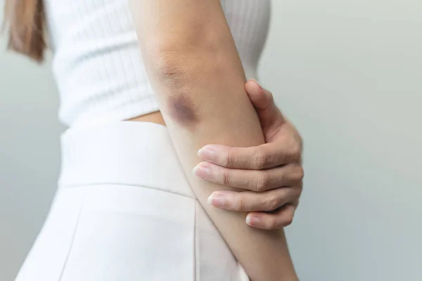 Woman Get Injured Have Bruised Her Arm — ストック写真