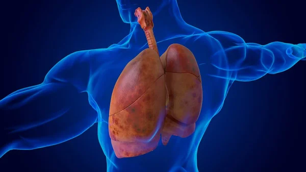 医学的概念のための人間の損傷肺解剖図3Dイラスト — ストック写真