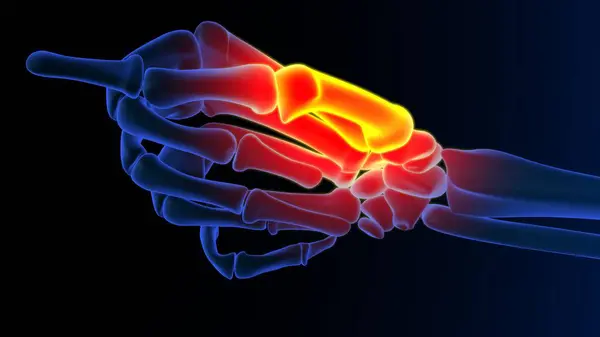 Thumb metacarpal bone pain anatomy for medical concept 3D illustration