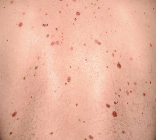 human back with moles