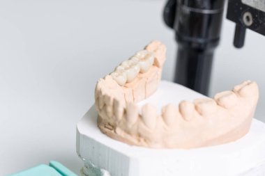 Bir diş laboratuarındaki eklem makinesi / protez eyerine diş implantı takıldı.