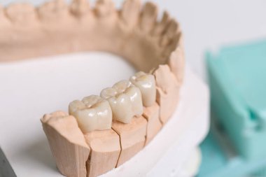 Bir diş laboratuarındaki eklem makinesi / protez eyerine diş implantı takıldı.