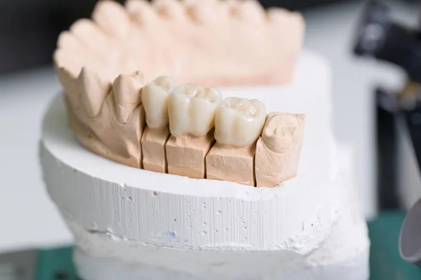 Primo Piano Impianto Dentale Articolatore Sella Protesica Laboratorio Odontoiatrico — Foto Stock
