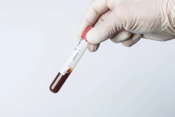 Close Handling Blood Probes Analyzing Laboratory — Stock Photo, Image