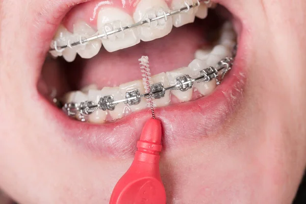 Primer Plano Boca Una Mujer Adolescente Con Corsé Dental Limpiarse — Foto de Stock