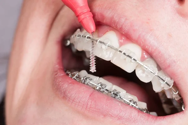Close-up of a woman\'s or teenager\'s mouth with a dental brace is cleaning her teeth with an interdental brush