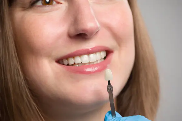 Close-up of dentist using shade guide at woman's mouth to check veneer