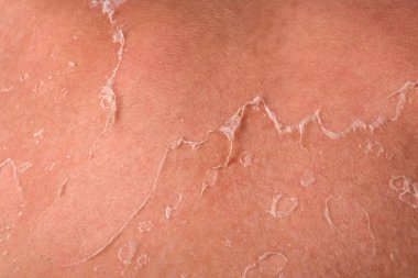 Güneş yanığı ve ultraviyole ışığa bağlı olarak Omuzdaki Flaky Derisinin Yakın Çekimi.