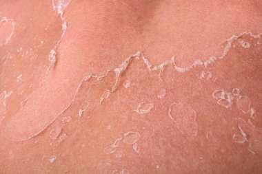 Güneş yanığından sonra cilt soyma, İyileşme Süreci ve Güneş Hasarını Gösterme.