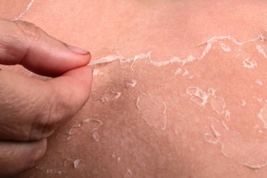 Güneş yanığından sonra Soyulan Derinin Kapanışı Kuraklık, Hasar ve İyileşme Sürecini Gösteriyor.