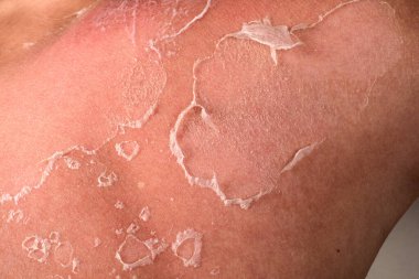 Omzunda Güneş Yanığı Derisinin Yakın Çekimi Hasar ve Doğal İyileştirme Sürecini Gösteriyor.