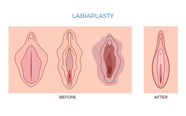 Labiaplasty Vaginoplastik Kvinnor Genital Mindre Vulval Blygdläppar Lös Läppar Skönhet — Stock vektor
