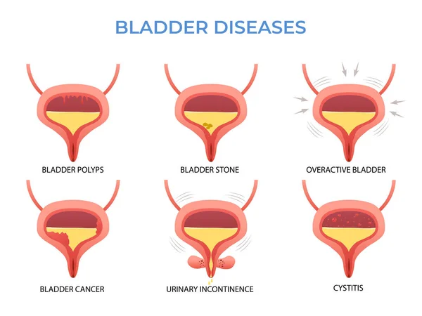 Urología Sistema Urinario Enfermedades Bladder — Vector de stock
