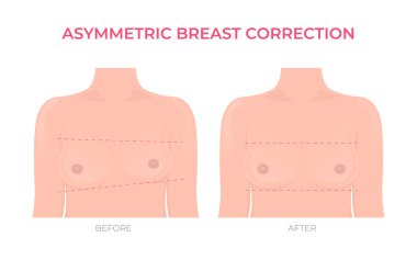 Asymmetric breast correction before and after plastic surgery front view clipart
