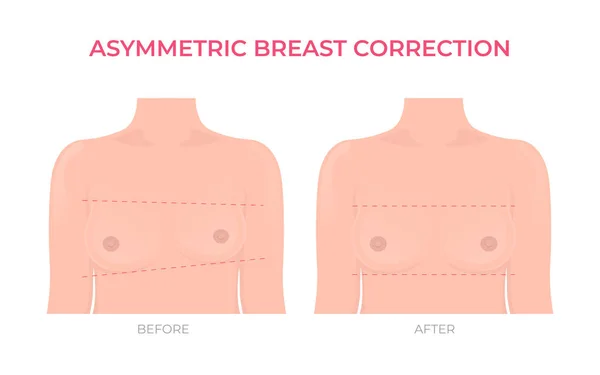 Asymmetrische Brustkorrektur Vor Und Nach Der Plastischen Chirurgie — Stockvektor