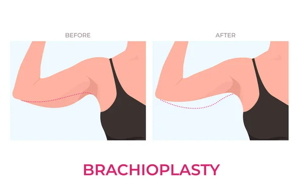 Brachioplasty Cirurgia Plástica Elevador Braço Superior Mulher Vista Frontal —  Vetores de Stock