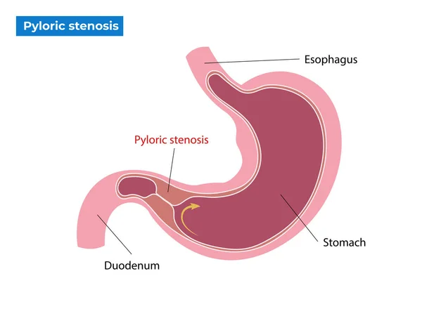 Tünetei Pyloricus Stenosis Vektor Illusztráció — Stock Vector