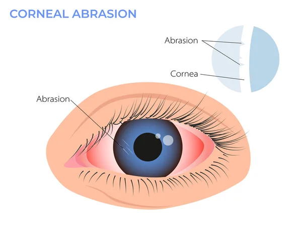 Illustrazione Dell Abrasione Corneale Sintomo Arrossamento Oculare Occhio Surfista Rosso — Vettoriale Stock