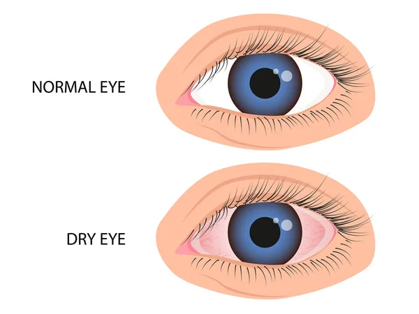 人間の目は健康で乾燥しています 皮膚炎の症状 アレルギー 結膜炎 水疱症 — ストックベクタ