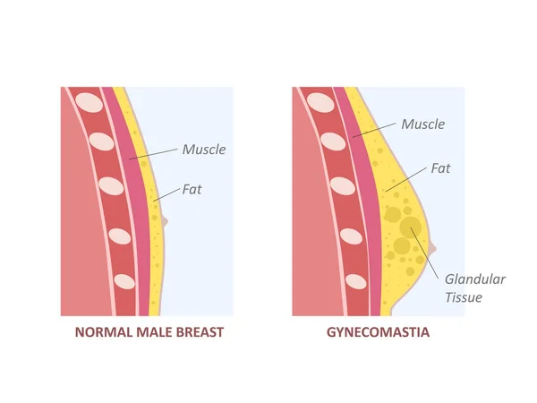 Desequilibrio Hormonal Entre Estrógenos Andrógenos Ginecomastia — Archivo Imágenes Vectoriales