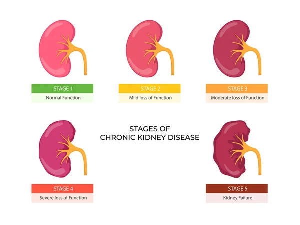Stages Chronic Kidney Disease Problem Urinary System Normal Kidney — Stock Vector