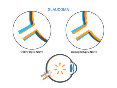 Glaucoma. Increased intraocular pressure, damaged optic nerve, vision loss. Human eye disease clipart