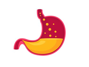 Gastroözofajiyal Reflü Hastalığı olan bir mide.