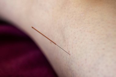 İyileşmek ya da rahatlamak için insan derisine saplanan akupunktur iğnesinin yakın plan portresi. Bir akupunkturcu bu alternatif ilacı hastalıkları, acıyı veya stresi tedavi etmek için sunar..