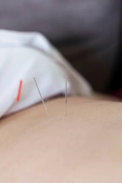 A close up portrait of an acupuncture needle sticking into a persons skin and body to heal or relax. An acupuncturist provides this alternative medicine for stress relief or to cure illness or pain.