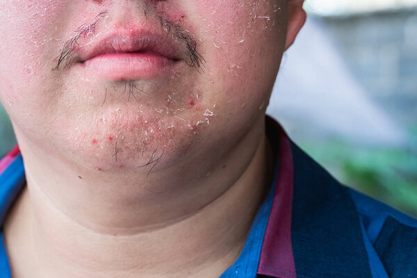 Close Face Skin Peels Sunburn Causing Itching Burning Stock Photo