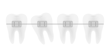 Ortodontik diş telleriyle yapılan diş düzeltmeleri. Dişlerin hizalanma aşamaları. Dişçi kliniği servisi. resimleme