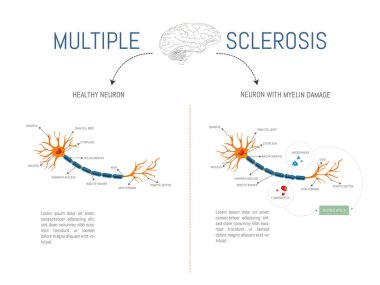 Infographic of a healthy neuron and one with damage from attack by myelin-destroying lymphocytes and macrophages in multiple sclerosis disease. clipart