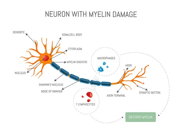 Infographic Ενός Νευρώνα Καταστραφεί Από Λεμφοκύτταρα Και Μακροφάγων Επίθεση Που — Διανυσματικό Αρχείο