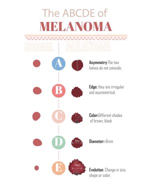 Melanom 'un ABCDE' si, beyaz arka planda melanom olup olmadığını bilmek için..