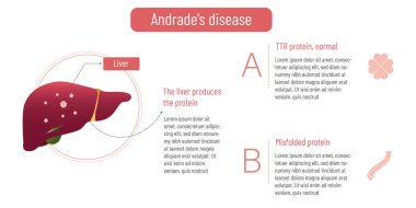 Andrade hastalığı. Yanlış katlanmış TTR proteini. Vektör EPS 10