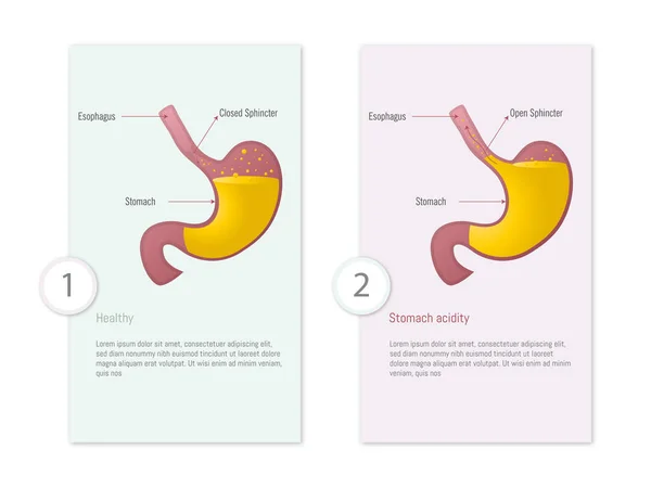 Infographic Stomach Healthy Stomach Acidity Colored Background Differentiate White Background — Stock Vector