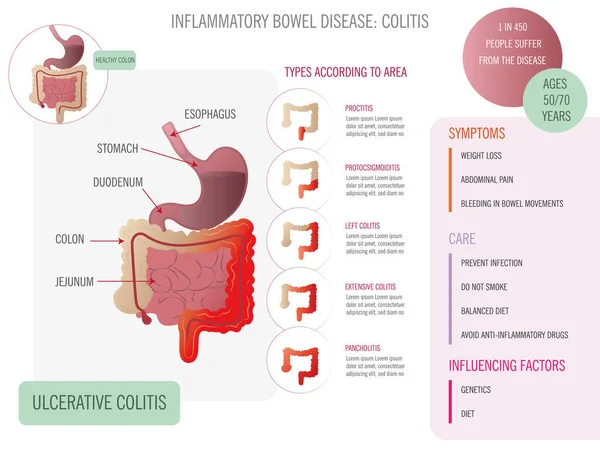Infografika Colitis Ulcerosa Típusairól Tüneteiről Gondozása Megfelelő Ikonok Fehér Alapon — Stock Vector