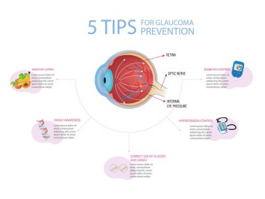5 tips for glaucoma prevention. Diagram of an eye with glaucoma on white background and surrounded by 5 tips for prevention.