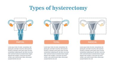 Infographic on risk factors in endometriosis.