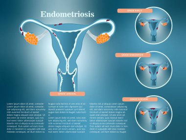 Infographic on risk factors in endometriosis.