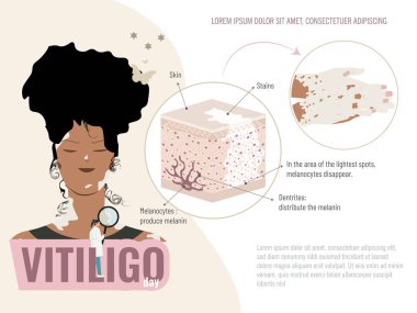 Siyah saçlı ve yeşil gömlekli bir kadına vitiligo adı verilen bir cilt hastalığının resmi gösterilir. Bu hastalıkla cildin grafiksel şeması. Vitiligo hastalığı eğitim kavramı.
