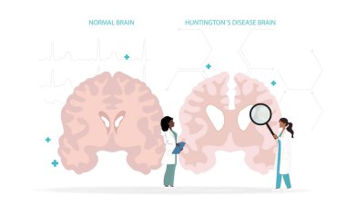 Huntington hastalığından etkilenen normal bir beyinle normal bir beyin karşılaştırması. İki araştırmacı bu nörodejeneratif hastalıkla ilişkili bozulmayı vurgulayarak yapısal farklılıkları analiz ediyor..