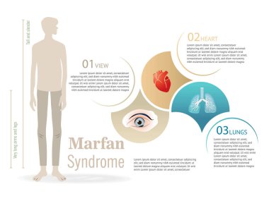 Yükseklik ve kalp ve akciğerler üzerindeki etkiler de dahil olmak üzere Marfan Sendromu 'nu betimleyen eğitici illüstrasyon