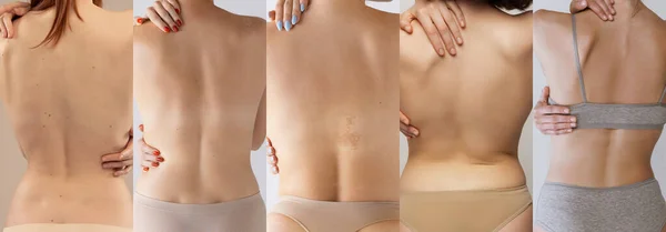 Collage Imágenes Recortadas Espaldas Femeninas Cuidar Después Salud Tratamiento Masaje —  Fotos de Stock