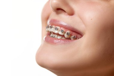 Dişlerinde yamuk diş ve doğru ısırık sorununu çözmeye yardımcı olan diş telleriyle gülümseyen kadın modelin kesilmiş portresi. Gençlik kavramı, doğal güzellik, hijyen, diş sağlığı, sağlık, ortodontik.