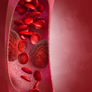 Tıbbi arka plan, arterde kolesterol plağı artmış seviye, 3 boyutlu illüstrasyon.
