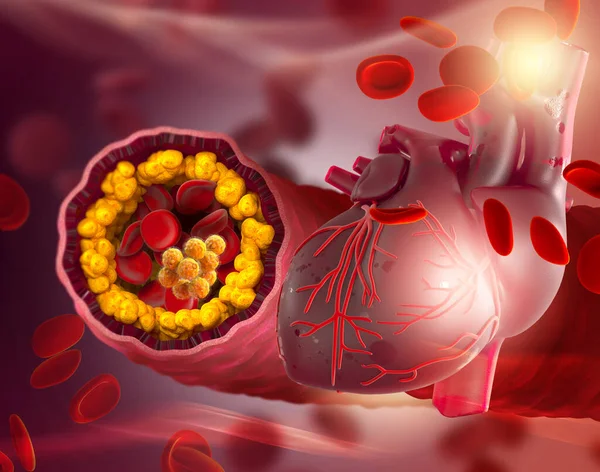 Zdravotní Zázemí Cholesterol Plak Tepně Zvýšená Hladina Ilustrace — Stock fotografie