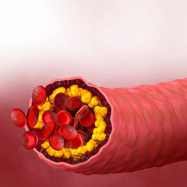 医学背景 动脉内胆固醇斑块增加 3D说明 — 图库照片