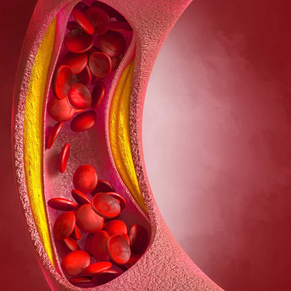 Zdravotní Zázemí Cholesterol Plak Tepně Zvýšená Hladina Ilustrace — Stock fotografie